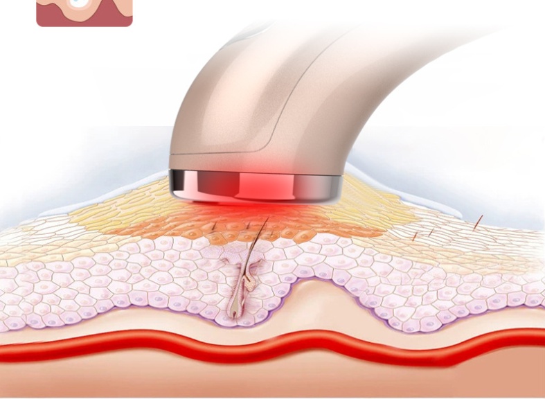 Far-Infrared Red Light Photon Skin Rejuvenation Instrument - Image 3