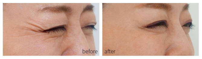 Household facial mask photon acne rejuvenation instrument - Image 4