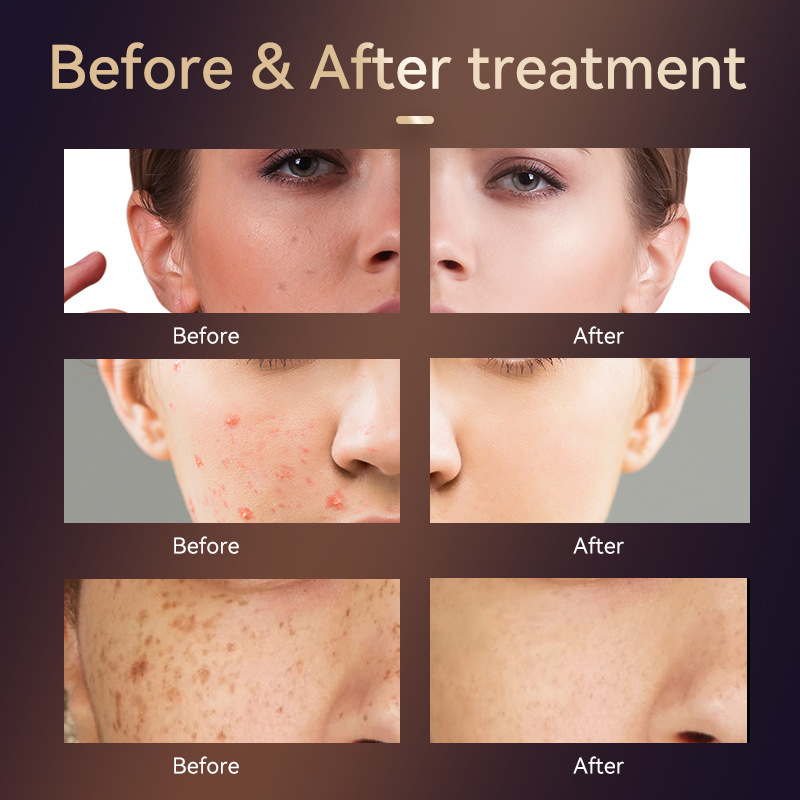Home Four Band Photon Rejuvenation Device for Whitening Brightening Spot Removal Anti Aging and Beauty - Image 4